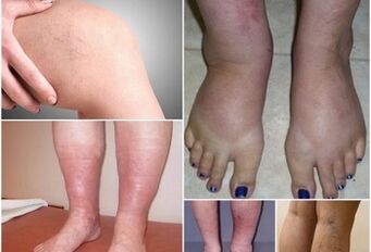 Pictures of manifestations of varicose veins in the legs