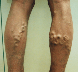traditional methods of treatment of varicose veins
