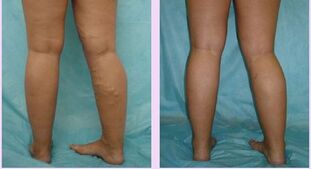 How varicose veins of the first stage manifests itself