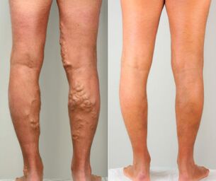 Stages of varicose veins of the legs