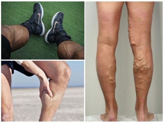 How do varicose veins look on men's legs