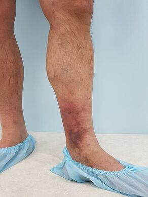 complications of varicose veins in men
