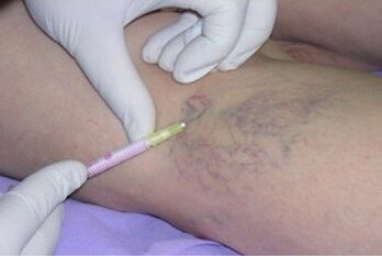 sclerotherapy as a method of treatment of varicose veins