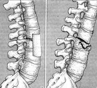 Injuries to the lumbar spine