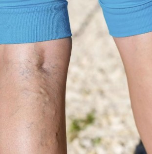 Varicose veins