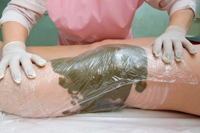 clay bandages against varicose veins