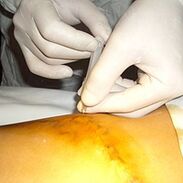 Miniphlebectomy is the most cosmetic treatment of varicose veins