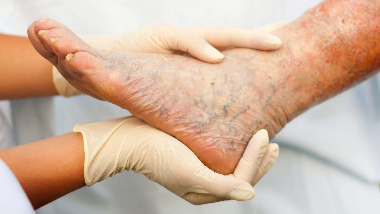 Phlebologist treats varicose veins in the legs
