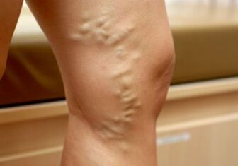 Varicose veins on the legs of a woman
