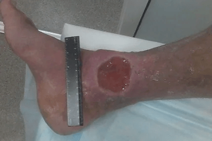 Varicosis complications of the veins
