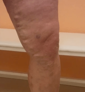 varicose veins