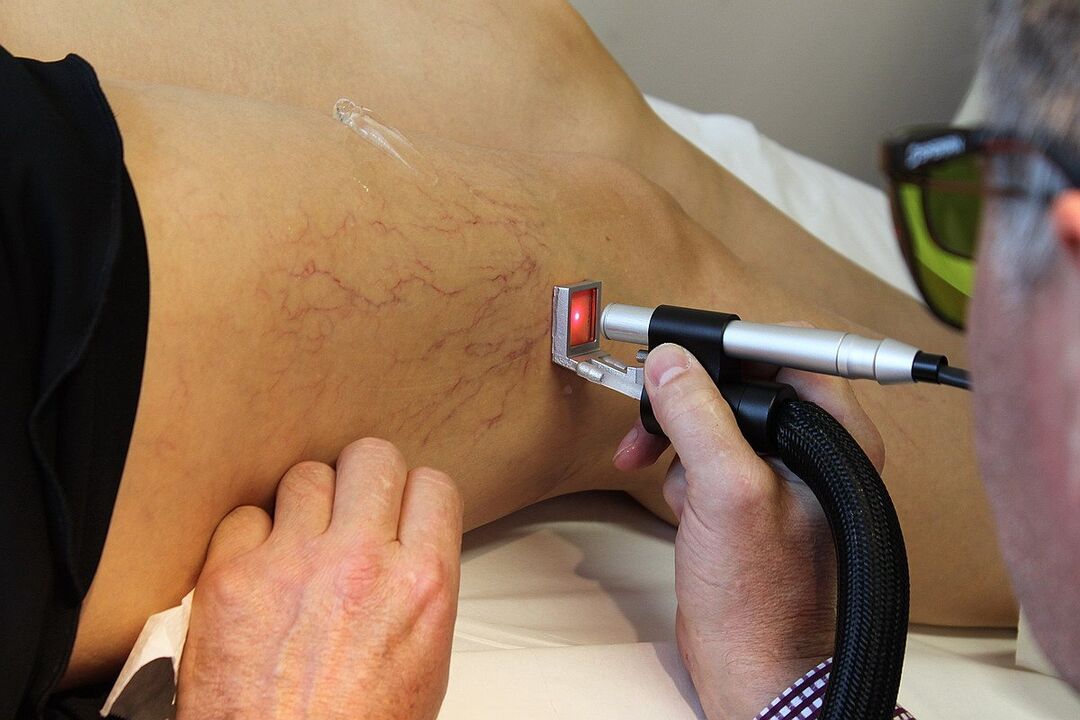 Laser clotting