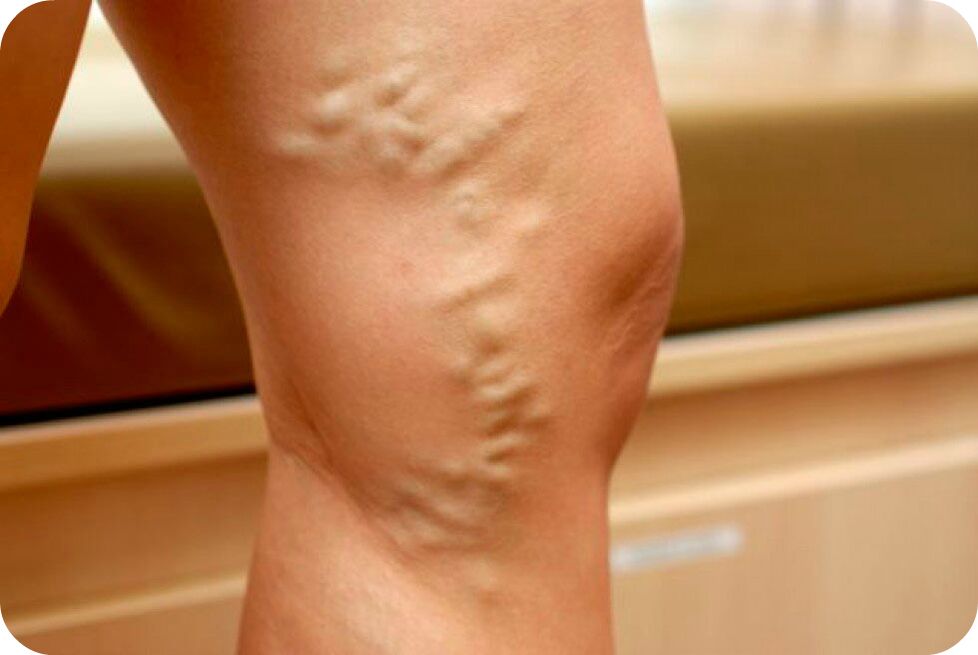 Varicosis vessels of the veins