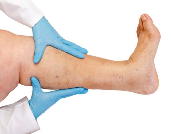 Varicosis veins in the legs