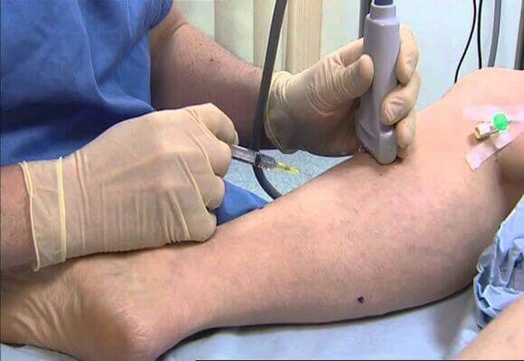 The treatment of varicose veins