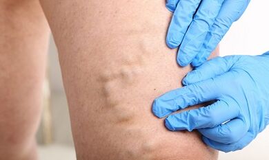 Varicosis veins in the legs