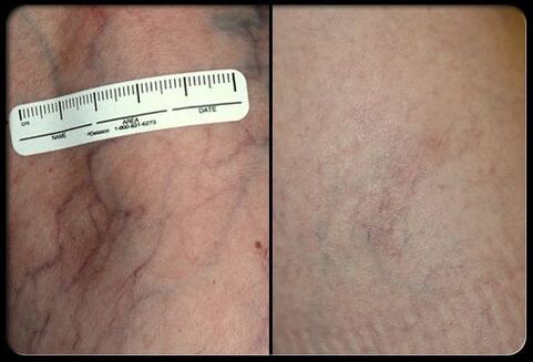 Before and after laser therapy procedure