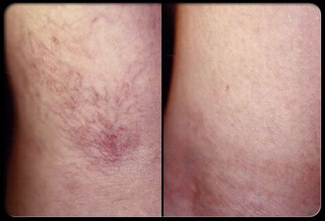 Before and after sclerotherapy