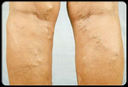 Varicosis veins in the legs