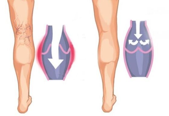 What varicose veins look like