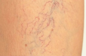 Initial stage of varicose veins