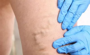 The treatment of varicose veins with the help of bioadhesive